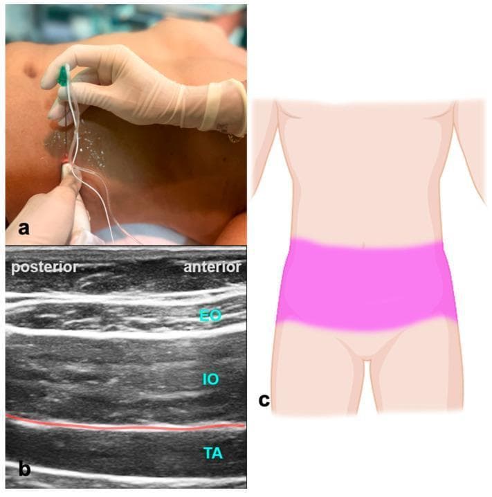 This composite educational image illustrates the Transversus Abdominis Plane (TAP) block procedure. Panel (a) shows a clinical photograph of the mid-axillary abdominal wall with an ultrasound transducer placed transversely and a needle inserted in-plane toward the lateral abdominal wall. Panel (b) is a high-frequency ultrasound image demonstrating the layered musculoskeletal anatomy of the abdominal wall. From superficial to deep, the external oblique (EO), internal oblique (IO), and transversus abdominis (TA) muscles are clearly visualized as hypoechoic structures separated by hyperechoic fascial planes. A red line indicates the target fascial plane for local anesthetic injection between the IO and TA muscles. Panel (c) is a schematic diagram showing the typical bilateral dermatomal spread of anesthesia across the lower abdomen (T10-L1) following a successful TAP block. This material is designed for teaching regional anesthesia techniques and ultrasound-guided nerve block landmarks.