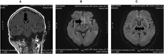 This diagnostic image set consists of three brain MRI panels (A, B, and C) demonstrating classic radiological findings of Wernicke's encephalopathy. Panel A is a coronal T2-weighted/FLAIR image showing symmetrical hyperintense signals in the periventricular region surrounding the third ventricle, highlighted by a vertical arrow. Panels B and C are axial Diffusion-Weighted Imaging (DWI) sequences demonstrating restricted diffusion characterized by high signal intensity within the bilateral basal ganglia and midline structures. Black arrows in the axial views indicate the symmetrical involvement of deep gray matter nuclei. These imaging findings are pathognomonic for thiamine deficiency-related neurotoxicity when correlated with clinical presentation. The modality demonstrates the importance of T2 and DWI sequences in identifying acute metabolic encephalopathy. This material is suitable for advanced medical education in neurology and neuroradiology, focusing on the identification of non-alcoholic Wernicke's encephalopathy manifestations.
