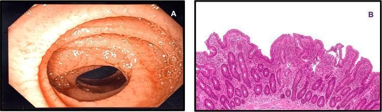 This dual-panel image displays diagnostic findings characteristic of Celiac disease in the second part of the duodenum. Panel A is an endoscopic photograph (clinical imaging) showing gross mucosal atrophy. Key visual features include the loss of normal mucosal texture and distinctive scalloping of the circular folds (plicae circulares). Panel B is a high-power light microscopy image of a duodenal biopsy stained with Hematoxylin and Eosin (H&E). It demonstrates histopathological changes classified as Marsh 3a, including moderate villous blunting (atrophy) and increased intraepithelial lymphocytosis. The educational focus is the correlation between endoscopic markers of malabsorption (scalloping) and the underlying microscopic structural damage (villous blunting and lymphocytic infiltration) used to confirm a gluten-sensitive enteropathy diagnosis in a clinical setting.