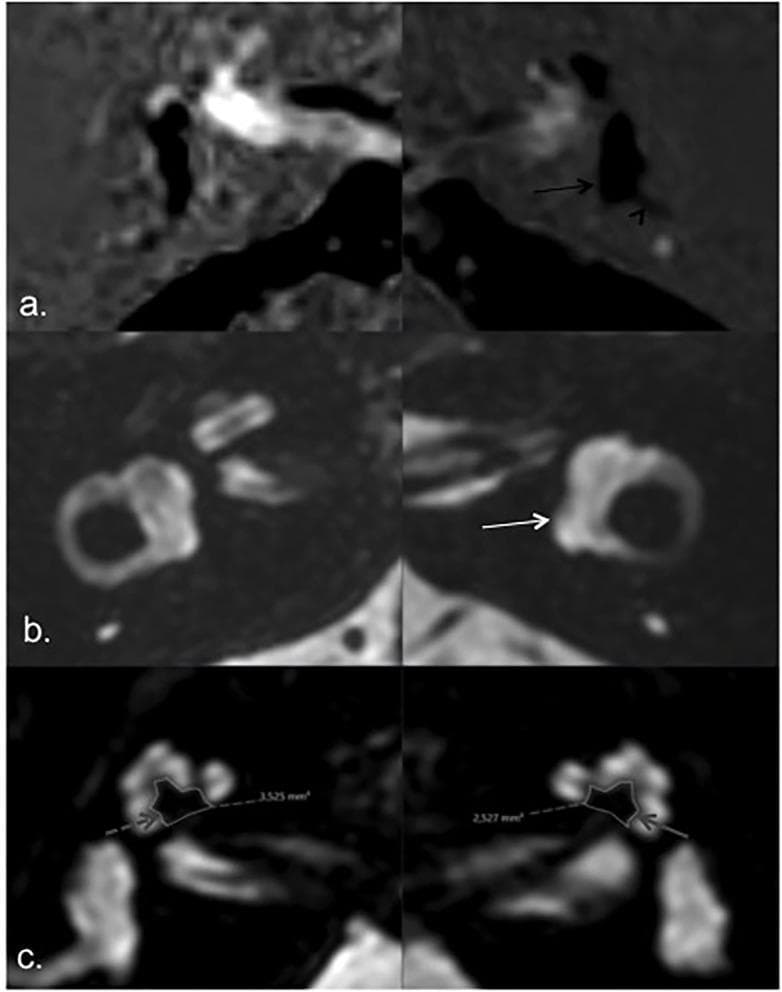 Multi-panel axial Magnetic Resonance Imaging (MRI) study of the inner ear focusing on Ménière’s disease pathology. Panel (a) displays HYDROPS sequences showing bilateral vestibular endolymphatic hydrops, with more severe distension on the left side (black arrow) and herniation of the utricle into the non-ampullary limb of the lateral semicircular canal (black arrowhead). Panel (b) presents axial T2-weighted images highlighting the total membranous labyrinth (white arrow). Panel (c) shows comparative axial T2 images focused on the cochlear modiolus area. The images demonstrate significant asymmetry between the 'index' (symptomatic) left ear and the asymptomatic right ear; the modiolar area on the left (solid gray arrow) is markedly smaller (2.327 mm²) compared to the right (3.525 mm², dashed gray arrow). This diagnostic imaging illustrates the relationship between endolymphatic hydrops and structural changes in the cochlear modiolus, relevant for otolaryngology and neurotology educational purposes.
