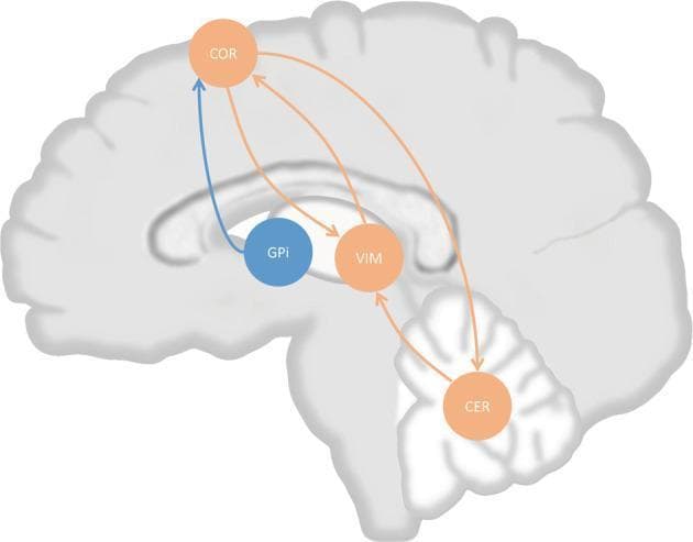 This pathophysiology diagram illustrates the 'dimmer switch' model of tremor in Parkinson's disease (PD) overlaid on a sagittal section of the human brain. The visual depicts the neural circuits involved in tremor generation and modulation. Key nodes include the cerebral cortex (COR), ventral intermediate nucleus of the thalamus (VIM), cerebellum (CER), and internal pallidal globus (GPi). Orange arrows represent the cerebello-thalamo-cortical (CTC) circuit, showing bidirectional connectivity between the COR and VIM, forming an oscillatory loop. The cerebellum (CER) provides unidirectional input to the VIM, while the COR projects back to the CER. A blue arrow highlights the tremor-triggering projection originating from the GPi and leading to the COR. The diagram serves as an educational tool to explain how tremor activity originates in the basal ganglia (GPi) and is subsequently maintained by cortico-thalamic oscillations and modulated in amplitude by cerebellar output. This model is critical for understanding the neuroanatomical basis of PD tremors and the rationale behind therapeutic targets like VIM deep brain stimulation.