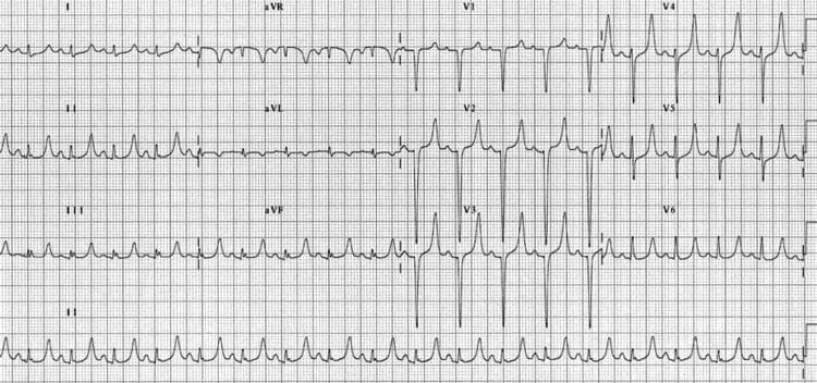 A 12-lead electrocardiogram (ECG) demonstrating visual characteristics of severe hyperkalemia. The tracing exhibits a regular sinus rhythm with notable conduction abnormalities. Key features include highly prominent, peaked T waves ('tenting'), which are most distinct in the inferior leads (II, III, and aVF) and across the precordial leads (V2–V5). The QRS complexes show significant widening (prolonged duration), indicating an intraventricular conduction delay. Additionally, the P waves appear flattened, a common progression in hyperkalemic states as potassium levels rise. The morphology shown is a classic educational example of how hyperkalemia affects cardiac electrophysiology, potentially progressing from peaked T waves to QRS widening and eventually a sine-wave pattern if untreated. This image is used to teach clinical recognition of electrolyte imbalances in emergency and intensive care settings.