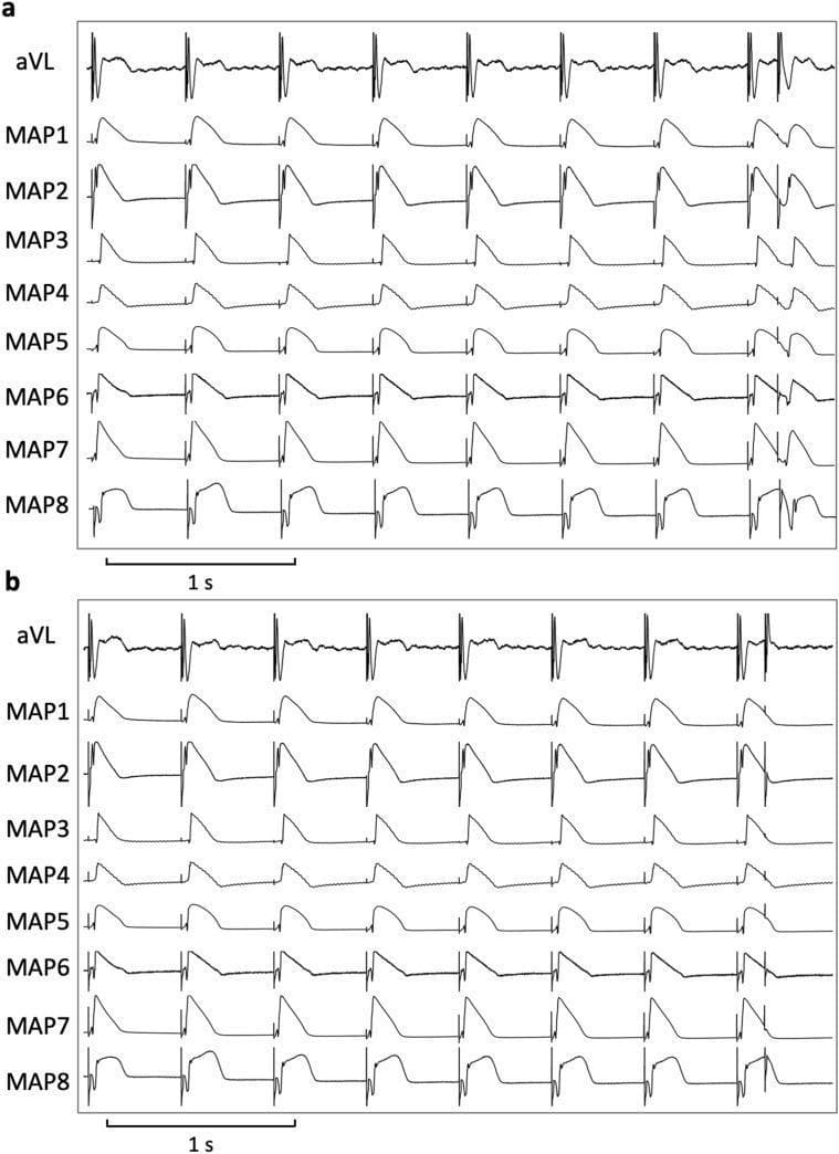 This diagnostic comparison chart displays electrocardiographic and electrophysiological data used to determine effective refractory periods (ERP) and spatial dispersion of repolarization. The image is divided into two stacked panels (a and b), each featuring a single-lead ECG tracing (aVL) at the top followed by eight simultaneous monophasic action potential (MAP1-8) recordings. The horizontal axis represents time with a 1-second scale bar provided. Each MAP trace illustrates the phases of the cardiac action potential, including the rapid depolarization upstroke, the plateau phase, and the repolarization phase. The figure demonstrates the cardiac response to programmed electrical stimulation, characterized by a series of regularly paced beats followed by a premature extra-stimulus (S2). Variations in action potential duration (APD) and morphology are visible across the different recording sites (MAP1-8), reflecting spatial heterogeneity in ventricular repolarization. This type of visualization is critical in cardiology research for assessing ventricular vulnerability to arrhythmias and calculating post-repolarization refractoriness (PRR).