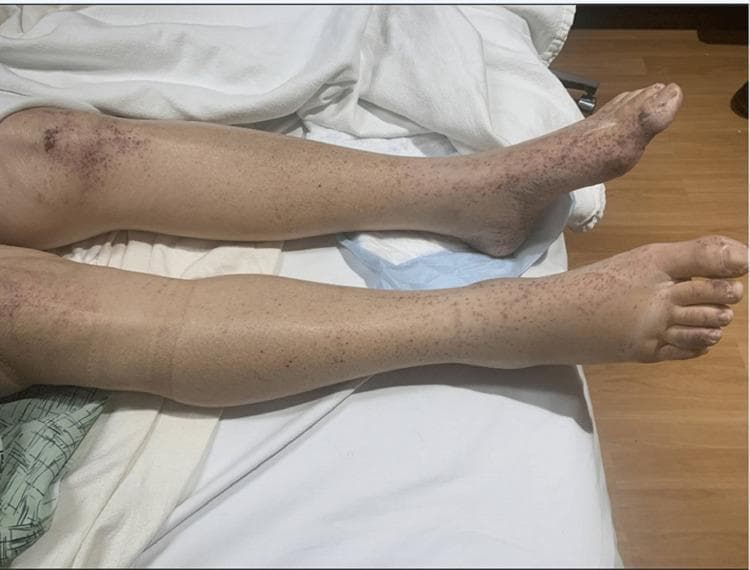 Clinical photograph of bilateral lower extremities from the knees to the feet, illustrating a widespread purpuric rash. The lesions consist of numerous reddish-purple, non-blanching petechiae and palpable purpura. The distribution is diffuse but demonstrates significant clustering and confluence over the patellar regions (knees) and distal extremities, including the ankles and dorsum of the feet. On the knees, the lesions form dark, dense ecchymotic-like patches. Distally, the feet and ankles show mild soft tissue swelling suggestive of dependent edema. The calves exhibit a more sparse, punctate distribution of petechiae. This visual presentation is characteristic of small-vessel vasculitis, such as IgA vasculitis (Henoch-Schönlein purpura) or leukocytoclastic vasculitis, where inflammation leads to the extravasation of red blood cells into the dermis. The density of lesions in dependent areas like the feet and friction-prone areas like the knees is a key clinical finding for medical students and clinicians.