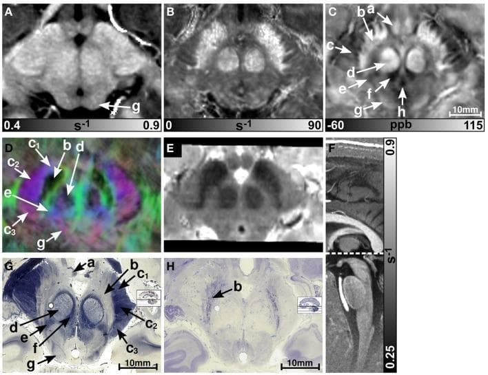 A multi-modal neuroimaging and histological comparison of the human midbrain. Panels A-E display axial sections at the level of the superior colliculus using various MRI contrasts at 7T: (A) R1 relaxation rate map, (B) R2* relaxation rate map, (C) quantitative susceptibility map (QSM), (D) direction-encoded track-density imaging (TDI), and (E) T2-weighted imaging. Panel F provides a sagittal R1 map for anatomical orientation. Panels G and H show corresponding axial histological sections stained for myelin (Luxol Fast Blue) and cellularity (Nissl), respectively. Key anatomical structures labeled include the substantia nigra (b), red nucleus (d), crus cerebri (c) containing corticobulbar (c1), corticospinal (c2), and corticopontine (c3) fibers, and the medial lemniscus (e). The QSM and R2* maps provide superior visualization of the iron-rich substantia nigra and red nucleus compared to R1. The TDI image uses color-coding to represent fiber anisotropy: red for medial-lateral, blue for superior-inferior, and green for anterior-posterior orientations, successfully delineating white matter bundles in the crus cerebri.
