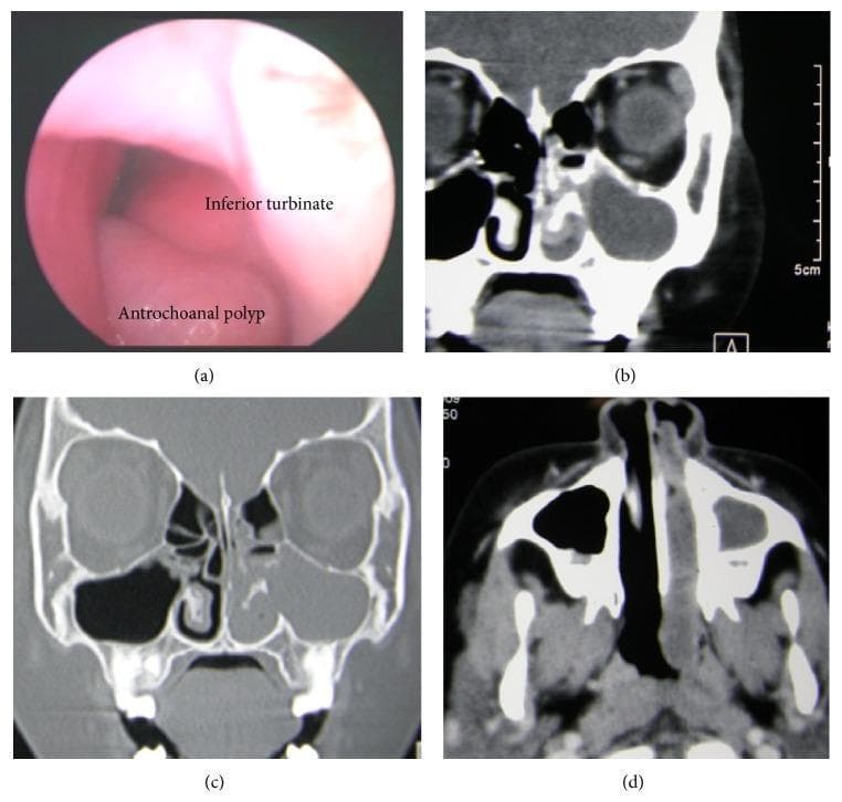 This composite clinical figure illustrates an antrochoanal polyp (ACP) through multi-modal imaging: endoscopy and computed tomography (CT). Panel (a) shows an endoscopic view of the left nasal cavity, identifying a smooth, pale mass located inferiorly at the level of the inferior meatus, adjacent to the inferior turbinate. Panel (b) is a coronal CT scan in a soft tissue window demonstrating a large cystic-appearing mass occupying the maxillary antrum. Panel (c) provides a coronal bone window CT, highlighting a focal defect in the medial wall of the maxillary sinus situated below the inferior turbinate, serving as the exit point for the polyp into the nasal cavity. Panel (d) displays an axial CT scan where the soft tissue mass is seen extending posteriorly from the nasal cavity into the nasopharynx. This sequence demonstrates the characteristic tri-compartmental progression of an ACP from the maxillary sinus, through the nasal meatus, and into the choana/nasopharynx, including rare inferior meatus involvement.