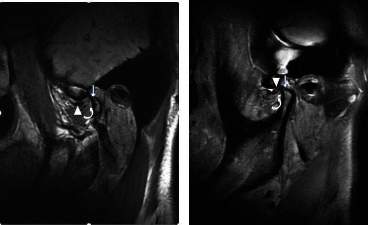 This diagnostic comparison contains two magnetic resonance imaging (MRI) views of the temporomandibular joint (TMJ) illustrating different stages of internal derangement. Image (a) demonstrates an irreducible anterior articular disc displacement. Specific pathology includes the anteriorly displaced disc (arrow), notable thickening at the attachment point of the inferior branch of the lateral pterygoid muscle (curved arrow), and secondary degenerative changes evidenced by condylar hyperosteogeny (straight arrow). Image (b) shows the contralateral side presenting with a reducible anterior articular disc displacement. While the disc is also displaced anteriorly (arrow), the lateral pterygoid muscle attachment point (curved arrow) appears normal in thickness, and there is an absence of the hyperosteogeny seen in the irreducible state. This comparison serves as an educational reference for identifying radiological signs of chronic TMJ disc displacement and associated muscle/bone remodeling, emphasizing the anatomical differences between reducible and irreducible internal derangements.