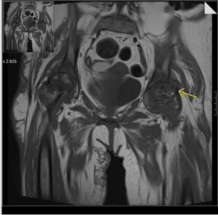 This diagnostic image is a coronal view Magnetic Resonance Imaging (MRI) of the pelvis, primarily demonstrating bilateral avascular necrosis (AVN) of the femoral heads. Both femoral heads exhibit characteristic serpiginous, low-signal intensity lines circumscribing the infarcted areas, consistent with late-stage osteonecrosis. There is evidence of significant structural progression, including an advanced loss of joint space and articular cartilage bilaterally. A yellow arrow points specifically to a subchondral collapse at the superolateral aspect of the left femoral head, indicating secondary osteoarthritis and joint surface irregularity. Surrounding soft tissues show evidence of complex effusions and synovial thickening, potentially indicating secondary synovial osteochondromatosis. Additionally, the image displays diffuse muscular oedema and atrophy of the surrounding pelvic and proximal thigh musculature, most notably in the right rectus muscle. This visual material is clinically relevant for orthopedic surgical planning, such as total hip arthroplasty, and for teaching the radiological hallmarks of Stage IV/V avascular necrosis using the Ficat or Steinberg classification systems.
