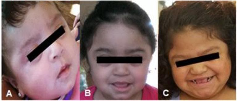 A series of three longitudinal clinical photographs (A, B, C) documenting the progressive facial phenotype of a female patient with Mucopolysaccharidosis type II (MPS II), or Hunter syndrome. Image A shows the patient as an infant with subtle facial features. Image B depicts the patient as a toddler, where a transition toward coarser facial features begins to emerge. Image C shows the patient at the time of presentation with the classic 'coarse' facies characteristic of severe MPS II. Visible features include a thickened, prominent forehead, a flattened nasal bridge with a broad nose, full lips, and macroglossia. Notable dental findings in image C include widely spaced, peg-shaped teeth and gingival hypertrophy. The hair appears progressively coarser and thicker throughout the timeline. This progression illustrates the metabolic accumulation of glycosaminoglycans (GAGs) in connective tissues, leading to the distinctive dysmorphic features used in the clinical diagnosis of lysosomal storage diseases.