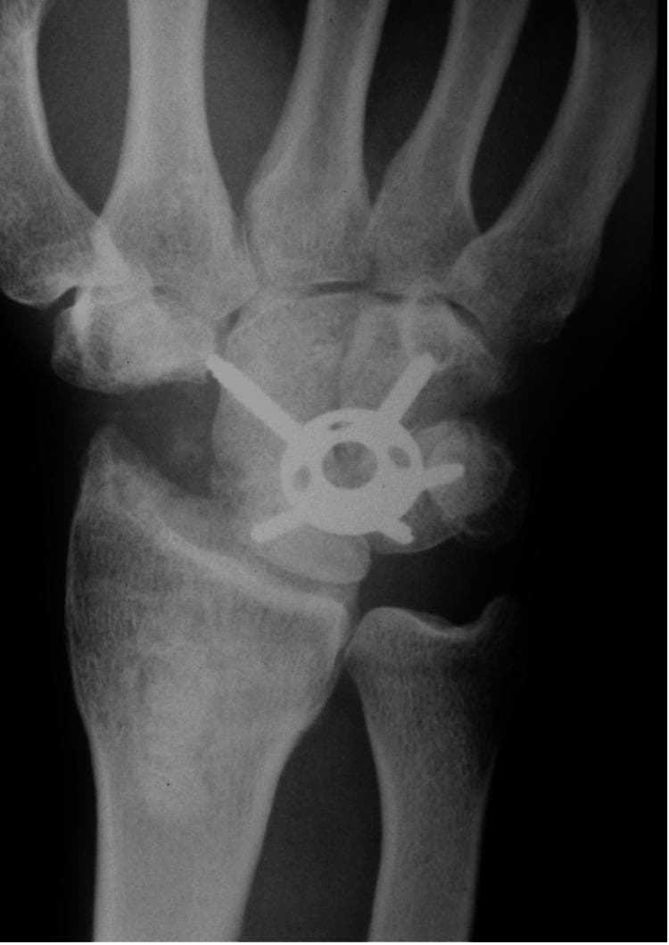 This anteroposterior (AP) x-ray radiograph of the wrist demonstrates a four-corner fusion (4-CF) procedure, a common surgical intervention for advanced carpal collapse conditions such as Scapholunate Advanced Collapse (SLAC) or Scaphoid Non-union Advanced Collapse (SNAC). The image clearly shows the surgical excision of the scaphoid bone, leaving an empty space in the radial aspect of the carpus. Central to the carpal region is a metallic circular plate with radiating screw fixation points. This circular spider plate rigidly secures the lunate, capitate, hamate, and triquetrum bones to promote intercarpal arthrodesis. The radio-lunate joint space appears preserved, which is a functional goal of this procedure. Radiographic features of fusion include the hardware's position spanning the four bones and the loss of discrete joint lines between the involved carpals. This visual is highly relevant for orthopaedic surgery and radiology education, illustrating the hardware configuration and anatomical changes following limited wrist arthrodesis.