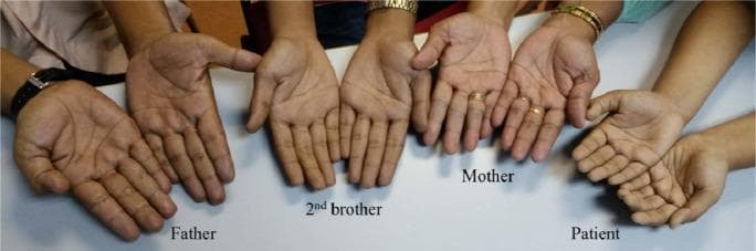 A clinical photograph displaying the palms of four family members side-by-side to illustrate phenotypic differences in skin coloration. From left to right, the hands belong to the father, the second brother, the mother, and the patient. A clear contrast is visible between the unaffected mother and the other three family members. The mother's palms exhibit a normal, healthy pinkish-tan hue. In contrast, the father, brother, and patient show a distinct dusky, grayish-blue discoloration (cyanosis), particularly noticeable in the nail beds and palm creases. This visual finding is characteristic of methemoglobinemia, specifically Hemoglobin M (Hb-M) disease, where the presence of ferric iron prevents normal oxygen binding, resulting in persistent clinical cyanosis despite normal oxygen saturation levels. The image serves as a comparative tool for recognizing hereditary hemoglobinopathies and understanding the autosomal dominant inheritance pattern of Hb-M, as the condition is clearly expressed in the father and two of his children, but absent in the mother.