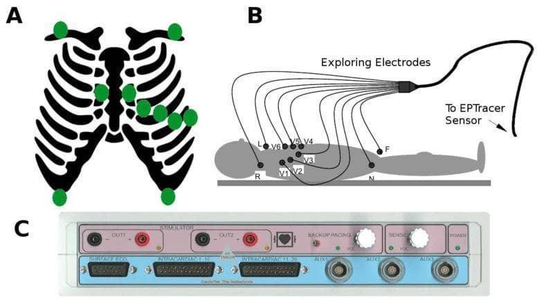 This composite educational graphic illustrates the configuration and hardware for electrocardiogram (ECG) recording. Panel A is an anatomical diagram showing the skeletal thorax with green markers indicating standard electrode placement sites, including the precordial and limb leads. Panel B presents a schematic of a human subject in the supine position, detailing the connection of exploring electrodes (labeled R, L, F, N, and V1–V6) to an EPTracer sensor system. This panel demonstrates the standardized 12-lead ECG nomenclature and the spatial distribution of chest and limb leads used to calculate potential differences against the Wilson central terminal. Panel C is a clinical photograph of the EPTracer sensor front panel, a specialized electrophysiological measurement device. The panel displays various interfaces including stimulator outputs (OUT1, OUT2), specialized ports for surface ECG and intracardiac signal acquisition, and auxiliary inputs. Control knobs for backup pacing and sensing parameters are also visible, highlighting the device's capability for both diagnostic recording and therapeutic cardiac pacing in clinical or experimental electrophysiology environments.