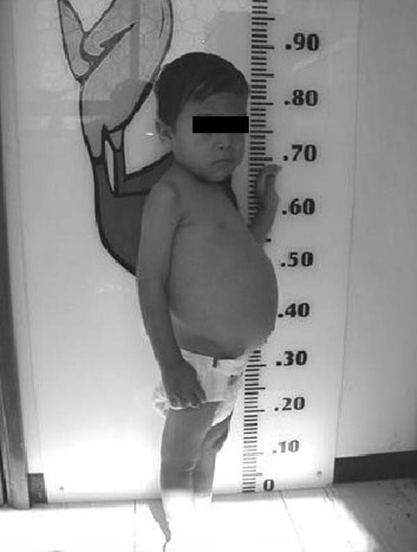 This clinical photograph shows a toddler-aged child in a lateral-oblique view, positioned against a height measurement chart to demonstrate growth parameters. The image illustrates classic clinical manifestations of severe malabsorption or untreated celiac disease. Significant features include marked abdominal distention (protuberant abdomen) contrasting with hypotrophic upper and lower limbs, which exhibit visible muscle wasting and loss of subcutaneous fat. This body composition is indicative of failure to thrive and chronic malnutrition in a pediatric patient. The child's height is shown relative to the metric scale, supporting a clinical assessment of growth retardation or being below the fifth percentile for age. The image serves as an educational example of the physical signs associated with gastrointestinal malabsorptive disorders and their impact on pediatric development.