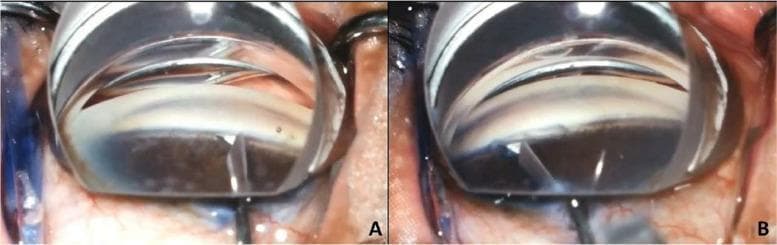 This clinical photograph displays two panels (A and B) showcasing the surgical steps of Bent Ab interno Needle Goniotomy (BANG), a minimally invasive glaucoma surgery (MIGS). The images are captured through a surgical gonioscopy lens, which provides a clear, magnified view of the anterior chamber angle of the eye. In Panel A, a 25-gauge angled needle tip is shown making contact with and penetrating the nasal trabecular meshwork. The needle is positioned to access Schlemm's canal. In Panel B, the post-incisional result is visible, demonstrating a 90-degree sectoral excision of the trabecular meshwork across the superonasal, nasal, and inferonasal quadrants. The surgical lens appears as a transparent, dome-shaped interface on the corneal surface. This educational visual illustrates the precise anatomical targeting required to enhance aqueous humor outflow in the management of intraocular pressure. The imagery is intended for advanced ophthalmology education, specifically focusing on surgical techniques for glaucoma treatment.
