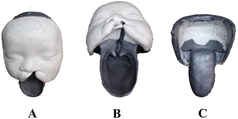 This clinical educational image displays three views (A, B, C) of a plaster cast model derived from a 6-month-old infant with a congenital complete unilateral cleft lip and palate. View A (Anterior) shows the external facial structure, highlighting a significant cleft on the left side that disrupts the upper lip and nasal base. View B (Inferior/Basal) provides a comprehensive look at the internal defect, demonstrating a complete cleft through the alveolar ridge (jaw), hard palate, and soft palate, showing direct communication between the oral and nasal cavities. View C (Posterior) illustrates the dorsal aspect and the pharyngeal extension of the model. The model utilizes white plaster for the midface and forehead, while darker materials define the internal oral and pharyngeal structures. This specimen serves as an anatomical foundation for surgical simulators, specifically designed to teach undergraduate medical and dentistry students about orofacial cleft anatomy and surgical planning for repair procedures.