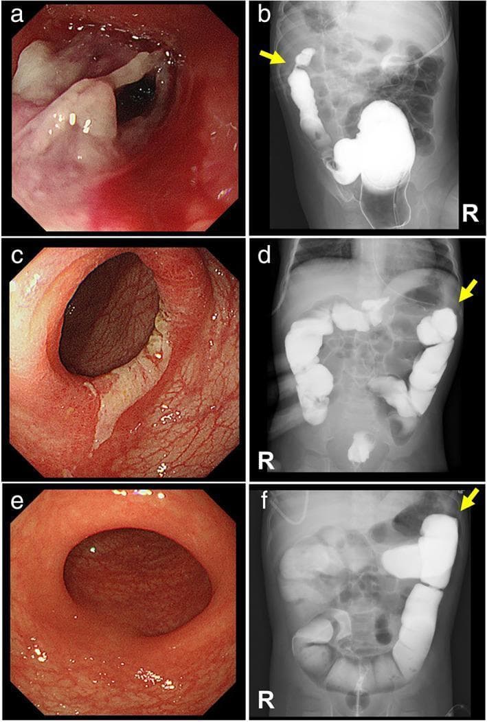 A multi-panel clinical graphic comparing endoscopic and radiological progression of ischemic colitis in a pediatric patient. Panels (a), (c), and (e) are colonoscopy images showing the evolution of the colonic mucosa. Panel (a) demonstrates acute phase mucosal sloughing with extensive off-white pseudomembrane formation and erythema. Panel (c) shows resolving inflammation with residual fibrin and regenerating epithelium. Panel (e) exhibits complete mucosal healing with normal vascular patterns and no pseudomembranes. Panels (b), (d), and (f) are contrast enemas (fluoroscopy) tracking structural changes at the splenic flexure (indicated by yellow arrows). Panel (b) reveals a significant focal stenosis with 'thumbprinting'—a sign of bowel wall edema. Panel (d) shows interval improvement of the luminal narrowing. Panel (f) demonstrates full resolution of the stenosis with a normal luminal diameter and contour. This sequence illustrates the transition from acute pseudomembranous colitis to structural stenosis and eventual complete clinical resolution, providing key visual hallmarks for gastroenterology and pediatric radiology education.