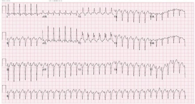 A 12-lead electrocardiogram (ECG) demonstrating a regular wide complex tachycardia (WCT). The rhythm is characterized by a rapid ventricular rate and broad QRS complexes, indicating delayed ventricular depolarization. Key morphological findings include a Right Bundle Branch Block (RBBB) pattern, notably visible as an RSR' or notched morphology in the right precordial leads (V1, V2). There is significant left axis deviation (LAD), with predominantly negative QRS complexes in the inferior leads (II, III, and aVF) and positive complexes in leads I and aVL. This combination of RBBB morphology and left axis deviation in the context of wide complex tachycardia is a classic presentation of idiopathic left ventricular tachycardia, also known as Belhassen tachycardia or verapamil-sensitive fascicular ventricular tachycardia. The rhythm appears monomorphic, and the baseline shows no clearly identifiable P waves, suggesting atrioventricular dissociation or retrograde conduction common in ventricular arrhythmias.