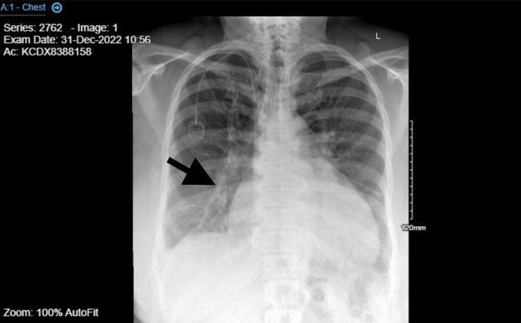 This diagnostic image is a posterior-anterior (PA) view chest X-ray demonstrating classic signs of congestive heart failure and acute pulmonary edema. Centrally, there is significant cardiomegaly with an increased cardiothoracic ratio, suggesting left ventricular enlargement. The pulmonary parenchyma shows widespread, bilateral increased opacification and haziness, particularly in the perihilar regions and lower lung zones, consistent with interstitial and alveolar edema. A black arrow in the right medial lung field specifically highlights enlarged, prominent pulmonary arteries and congested vascular markings (cephalization). The costophrenic angles appear partially obscured, which may indicate small pleural effusions. An implanted medical device, consistent with a chemotherapy port (Port-a-Cath), is visible in the right upper thoracic region with its catheter tip terminating in the superior vena cava. This visual evidence supports a clinical diagnosis of decompensated heart failure and pulmonary vascular congestion.