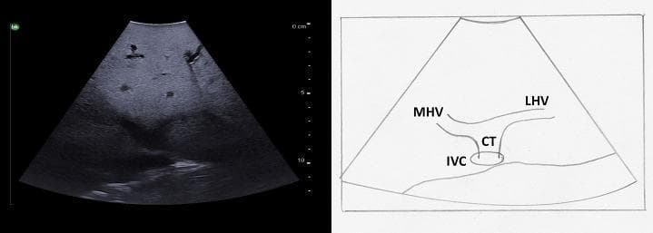 This medical visual consists of a clinical diagnostic ultrasound image alongside a labeled anatomical diagram illustrating hepatic venous anatomy. The B-mode ultrasound shows a transverse view of the superior liver. It demonstrates the confluence of the middle hepatic vein (MHV) and the left hepatic vein (LHV) as they merge to form a common trunk (CT). This trunk subsequently drains into the inferior vena cava (IVC), which appears as a circular or oval anechoic structure. The liver parenchyma exhibits a normal, medium-level echogenicity with a homogeneous texture and smooth surface. The accompanying line diagram provides anatomical context, clearly labeling the MHV, LHV, CT, and IVC to show their relative positions and the 'rabbit ears' appearance characteristic of this vascular junction. This content is intended for intermediate medical education, specifically for identifying segmental liver anatomy and vascular landmarks during intraoperative or diagnostic ultrasound examinations.
