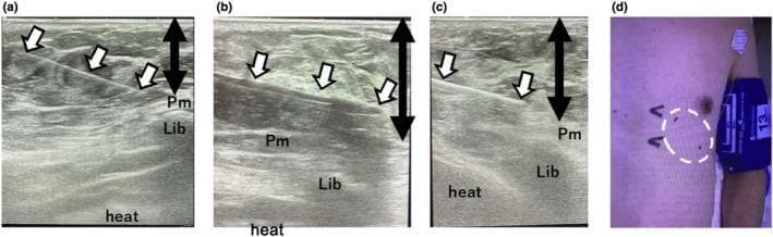 A multi-panel figure consisting of three real-time ultrasound images (a-c) and one clinical photograph (d) demonstrating the procedural steps for an implantable cardiac monitor (ICM) placement using tumescent local anesthesia (TLA). Ultrasound images a, b, and c show the cross-sectional anatomy of the left precordium, including the pectoralis major muscle (Pm), subcutaneous tissue (Lib), and the underlying heart. Image (a) depicts a 23-gauge needle (white arrows) inserted at an angle into the subcutaneous layer for TLA delivery, with a black double-headed arrow marking the target injection depth above the pectoralis major. Image (b) shows the insertion of a plunger stick (white arrows) from an ICM kit used to create a subcutaneous pocket. Image (c) visualizes the final implanted ICM (white arrows) positioned within the subcutaneous tissue. Image (d) is a clinical photograph of the patient’s chest, with a dotted white circle indicating the application area of the TLA on the left precordium. The series highlights ultrasound-guided techniques to ensure precise depth and localization of the device relative to anatomical landmarks.
