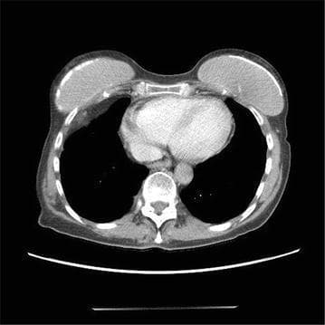 Axial non-contrast computed tomography (CT) scan of the thorax at the level of the heart, demonstrating normal cardiac anatomy and clear lung fields. The image features the heart centrally within the mediastinum, surrounded by the pulmonary parenchyma, which appears uniformly low-density (hypodense) indicative of normal aeration. The pericardium is visualized as a thin, crisp border without evidence of thickening or fluid accumulation, representing the complete resolution of a previous pericardial effusion. Key anatomical landmarks include the vertebral body posteriorly, ribs and thoracic wall musculature laterally, and breast tissue anteriorly. This diagnostic image serves as a clinical follow-up to monitor the response to steroid treatment in cases of immune-related adverse events (irAEs), specifically showing the absence of pericardial fluid or pleural effusions.