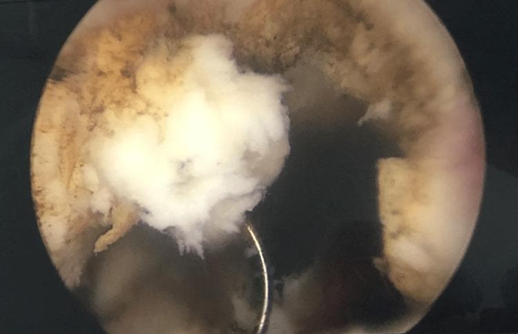 This endoscopic intraoperative image demonstrates a Transurethral Resection of the Prostate (TURP) procedure. The primary focus is a large, white, caseous-appearing mass measuring approximately 12 mm x 15 mm x 32 mm. The mass exhibits a distinct friable, 'fluffy,' and irregular texture, characteristic of tuberculous granulomatous lesions with central caseous necrosis. It is seen protruding from the prostatic urethra into the darker, open space of the bladder lumen, causing significant urinary tract obstruction. A metallic, curved surgical loop (resectoscope loop) is visible in contact with the inferior aspect of the white mass, illustrating the active resection process. The surrounding bladder neck and prostatic urethral tissue appear hyperemic with a brownish-red, rough surface texture, contrasting sharply with the pale necrotic material. This clinical photograph is used to teach the visual presentation of genitourinary tuberculosis as a cause of bladder outlet obstruction and its differentiation from typical benign prostatic hyperplasia or prostatic malignancy during endoscopy.