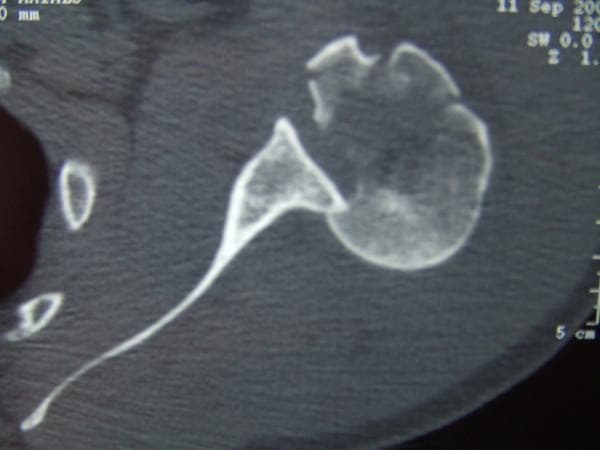 This axial CT scan slice of the shoulder demonstrates a posterior glenohumeral dislocation with associated complex fractures of the proximal humerus. The humeral head is displaced posteriorly relative to the glenoid fossa. A prominent 'reverse Hill-Sachs lesion' (trough line) is visible as an impaction fracture on the anterior aspect of the humeral head where it has abutted the posterior glenoid rim. Additionally, the image shows comminuted fractures involving the greater and lesser tuberosities, characterized by sharp cortical disruption and displaced bone fragments. The normal congruent relationship between the rounded humeral head and the concave glenoid is lost, illustrating a severe musculoskeletal injury pattern often resulting from high-energy trauma or forced internal rotation. This diagnostic image serves as a key educational example of posterior instability complications and the utility of computerized tomography in evaluating complex periarticular shoulder fractures.