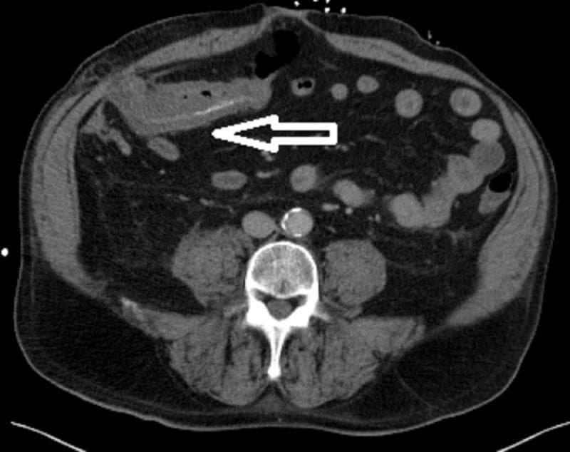 This diagnostic image is an axial computed tomography (CT) scan of the abdomen. The scan reveals a significant segment of circumferential colonic wall thickening involving the transverse colon, extending approximately 10 cm in length. A white arrow highlights a site on the abdominal wall representing a reduced Spigelian hernia, located at the lateral border of the rectus abdominis muscle. This specific segment of the transverse colon was previously herniated and now shows radiographic evidence of inflammation and edema. The surrounding mesenteric fat displays increased attenuation, suggestive of fat stranding. Other visible structures include the lumbar vertebra, abdominal aorta with calcification, and psoas muscles. In a clinical context, these findings are highly concerning for ischemic colitis following the reduction of an incarcerated or strangulated hernia. This image is used to teach medical students and residents about the complications of abdominal wall hernias and the CT appearance of secondary bowel ischemia.