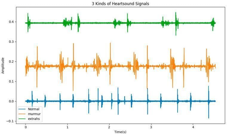 This Comparison Chart displays three distinct phonocardiogram (PCG) waveforms, representing heart sound signals over a 5-second interval. The chart illustrates three categories: Normal (blue), Murmur (orange), and Extrahs (green), plotted as amplitude over time. The 'Normal' waveform shows a rhythmic pattern of relatively low-amplitude spikes corresponding to the standard S1 and S2 heart sounds with consistent intervals. The 'Murmur' signal exhibits a more complex and erratic morphology characterized by higher amplitude spikes and high-frequency oscillations between the primary heart sounds, indicating turbulent blood flow. The 'Extrahs' (extra heart sound) signal features the highest amplitude spikes and additional sound components that appear rhythmically but at a lower frequency than the normal baseline. This diagnostic visualization is used in cardiology to demonstrate the temporal and acoustic differences between physiological and pathological heart sounds, aiding in the identification of cardiovascular diseases through digital auscultation analysis.