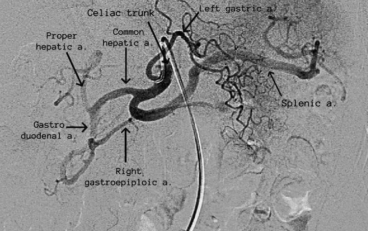 This diagnostic image is a selective digital subtraction angiography (DSA) of the abdominal celiac trunk, demonstrating normal vascular anatomy. The angiography utilizes radio-opaque contrast to highlight the trifurcation of the celiac artery. The three primary branches are clearly identified and labeled: the left gastric artery, which ascends toward the lesser curvature of the stomach; the splenic artery, which follows a characteristic tortuous course toward the spleen on the right side of the image; and the common hepatic artery. Further distal branching is visible, where the common hepatic artery divides into the proper hepatic artery and the gastroduodenal artery. The gastroduodenal artery is seen descending and giving rise to the right gastroepiploic artery. A diagnostic catheter is visible in the center of the frame, having been navigated into the trunk. This image serves as a high-quality anatomical reference for interventional radiology and vascular surgery education, illustrating the key arterial supply to the foregut organs including the liver, stomach, and spleen.