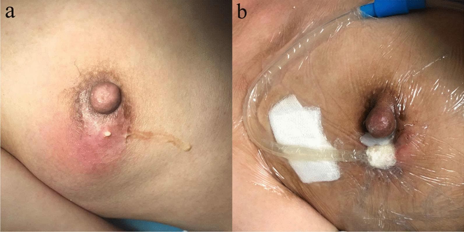 This clinical comparison photograph illustrates the management of a breast abscess using Vacuum Sealing Drainage (VSD). Image A (Preoperative) depicts an acute breast abscess involving the periareolar region. Key findings include prominent erythema, localized edema, and a spontaneous cutaneous fistula with visible purulent discharge. The nipple and areola show significant inflammatory changes consistent with suppurative mastitis. Image B (Post-intervention) shows the same anatomical site after 3 days of VSD treatment. The active medical setup consists of a specialized transparent semi-permeable adhesive film creating a hermetic seal over the breast, a drainage tube connected to a blue suction port, and white sterile dressing material positioned at the abscess site. There is a visible reduction in cutaneous erythema and swelling compared to the preoperative state. This comparison demonstrates the efficacy of negative pressure wound therapy in promoting the resolution of infection, managing exudate, and facilitating granulation tissue formation in complex soft tissue infections of the breast.