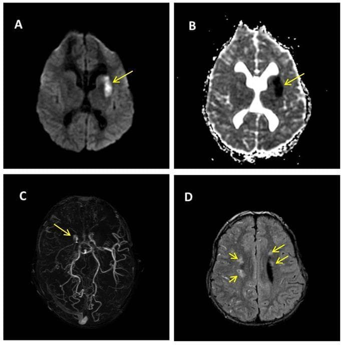 A multi-panel brain MRI demonstrating acute ischemic stroke and vascular stenosis in a pediatric patient. Panel (A) Diffusion-Weighted Imaging (DWI) and Panel (B) Apparent Diffusion Coefficient (ADC) map show an area of restricted diffusion (hyperintense on DWI, hypointense on ADC) in the left lenticular nucleus, anterior limb of the internal capsule, and the head and body of the caudate nucleus, consistent with an acute infarct. Panel (C) Time-of-Flight (TOF) Magnetic Resonance Angiography (MRA) reveals bilateral stenosis of the carotid siphon apices, most prominent on the right, with attenuated flow in the ipsilateral middle cerebral artery (MCA). Panel (D) Fluid-Attenuated Inversion Recovery (FLAIR) sequence demonstrates multiple punctate hyperintense signal alterations in the bilateral semioval centers, representing chronic ischemic changes or small vessel disease. Yellow arrows highlight the acute lesion (A, B), the vascular narrowing (C), and the white matter signal changes (D). The findings are highly suggestive of a progressive vasculopathy such as Moyamoya disease.