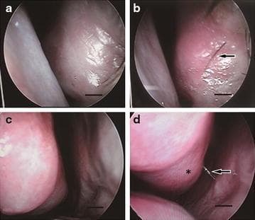 This set of four clinical endoscopic images (a-d) demonstrates the nasal cavity and turbinate morphology in patients with Empty Nose Syndrome (ENS) before and after regenerative treatment with fat tissue and adipose-derived stem cells (ADSCs). Panel (a) and (c) represent the preoperative state, showing a pale, atrophic nasal mucosa with diminished turbinate volume and limited secretions. Panel (b) highlights the emergence of rhinothrix (nasal hair, indicated by an arrow) on the regenerated mucosal surface. Panel (d) illustrates significant post-treatment recovery, characterized by more erythematous and healthy-appearing mucosa with increased mucus production (arrow) and the restoration of nasal turbinate morphology (asterisk). These images serve as visual evidence of mucosal regeneration and physiological recovery in the context of otorhinolaryngology and regenerative medicine, specifically for managing atrophic rhinitis and ENS. The clinical focus is on the structural and functional improvement of the nasal airway lining and turbinate bulk.