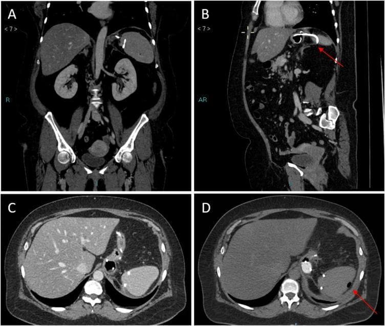 Multi-planar abdominal computed tomography (CT) scan with intravenous contrast demonstrating a complication following laparoscopic sleeve gastrectomy. The image is divided into four panels: (A) coronal view, (B) sagittal oblique projection, and (C/D) axial views. The primary finding is the partial intrasplenic displacement of an 8.5 Fr double-pigtail stent, originally placed to manage a gastric staple-line leak. In panel B, a red arrow highlights the distal tip of the radiopaque stent migrating along the vessel axis toward the splenic parenchyma. In axial panel D, a red arrow indicates a focal pocket of subcapsular air within the spleen, a pathognomonic sign confirming the malposition of the drain and violation of the splenic capsule. The imaging illustrates a rare iatrogenic complication of endoscopic internal drainage where the stent migrates from the perigastric collection into adjacent solid organ structures. This case is relevant for surgical and radiological education regarding the monitoring of endoscopic stents and the identification of post-operative anatomical displacement.