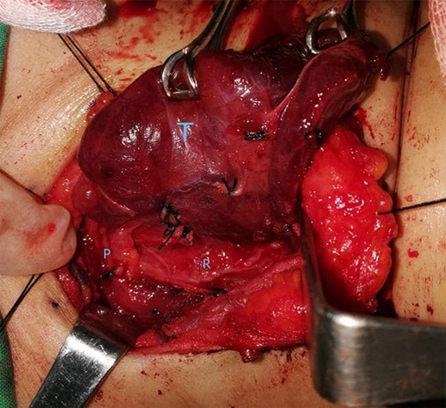 This clinical photograph displays an intraoperative view of the neck during a thyroidectomy procedure, focusing on the surgical anatomy of the thyroid bed before the application of methylene blue. The primary anatomical structures are labeled for educational identification: the thyroid gland (T) is visible as a superiorly located, reddish-brown vascular mass held by surgical forceps; the recurrent laryngeal nerve (R) is identified as a thin, pale, linear structure in the tracheoesophageal groove inferior to the thyroid lobe; and a parathyroid gland (P) is shown as a small, yellowish-tan nodule situated adjacent to the nerve and posterior thyroid capsule. The surgical field includes various instruments, such as retractors and forceps used for tissue manipulation, and black silk sutures are visible throughout the dissection site. This image serves as a clinical anatomical guide for identifying critical structures that must be preserved during endocrine surgery to prevent vocal cord paralysis or hypocalcemia. It illustrates the standard surgical topography and the natural appearance of these tissues in an active surgical field.