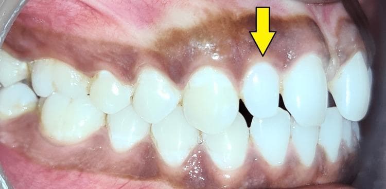 This clinical photograph is an intraoral, right lateral view of the maxillary and mandibular dentition. The primary focus is a peg-shaped lateral incisor (indicated by a yellow arrow), which demonstrates a characteristic microdontia characterized by a conical or tapered crown morphology that is significantly smaller than the adjacent central incisor. This dental anomaly has resulted in a localized diastema (gap) between the lateral and central incisors. The dentition displays a Class I molar and canine relationship. The surrounding gingival tissue and alveolar mucosa exhibit physiological hyperpigmentation, appearing as a diffuse dark brownish-purple hue across the keratinized and non-keratinized tissue. This image is an educational example of common dental developmental anomalies and their aesthetic impact on orthodontic alignment, typically addressed through restorative build-up or orthodontic space management.
