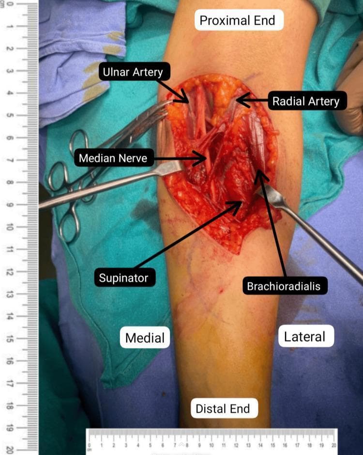 This clinical photograph captures an intraoperative view of a surgical decompression of the left median nerve at the level of the proximal forearm and cubital fossa. The image shows a deep dissection with anatomical structures clearly labeled. Centrally, the decompressed median nerve is visible, positioned between the medially located ulnar artery and the laterally located radial artery. Surrounding musculature is identified, including the brachioradialis muscle on the lateral border and the supinator muscle within the deep field. Surgical instruments, including a metal retractor and forceps, are shown retracting tissues to maintain exposure of the neurovascular bundle. Orientation labels indicate proximal, distal, medial, and lateral directions relative to the patient's limb. The surgical field demonstrates the successful release of potential compression sites, such as the lacertus fibrosus and the pronator teres heads, to treat median nerve entrapment. A centimeter ruler is placed alongside for scale, emphasizing the anatomical precision required for peripheral nerve exploration.