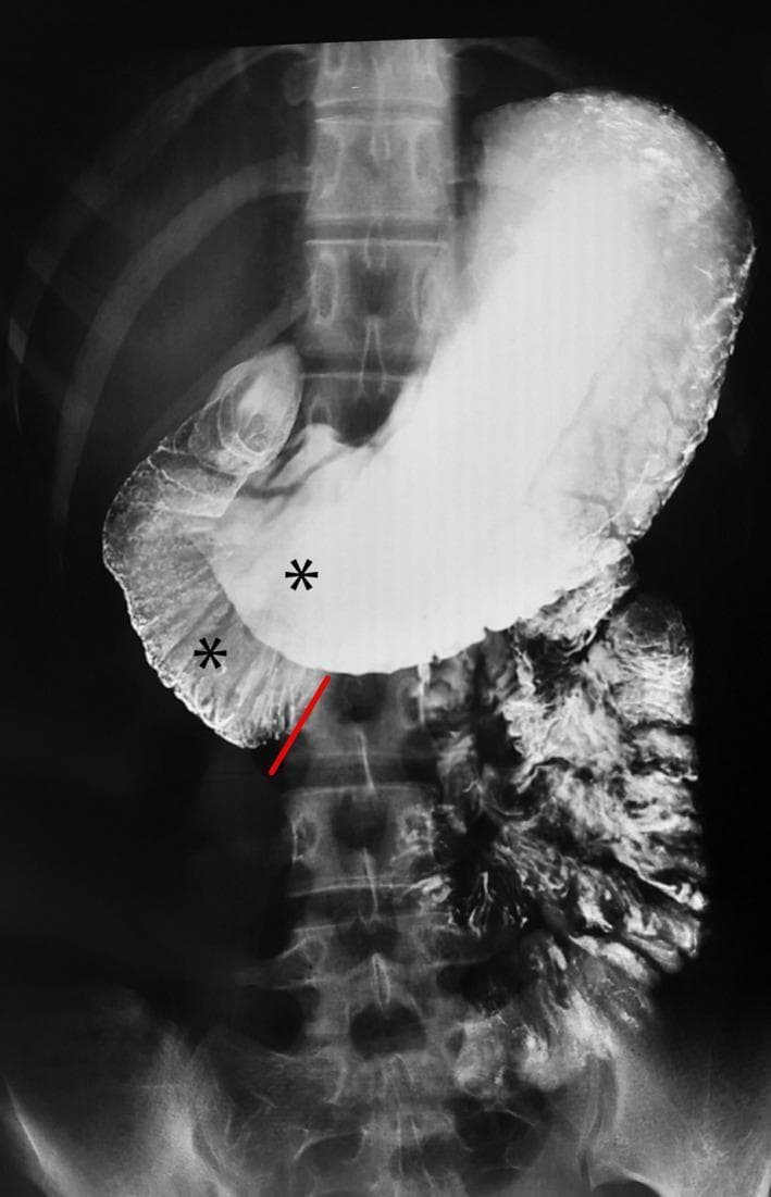 This diagnostic image is a barium meal radiograph (upper gastrointestinal series) showing the stomach and proximal duodenum. The image demonstrates a significantly distended, contrast-filled stomach and marked dilatation of the first and second parts of the duodenum (indicated by asterisks). A clear, linear, abrupt cutoff of the barium column is visible at the third (transverse) part of the duodenum, highlighted by a red annotation line. This 'cutoff sign' suggests an extrinsic compression or obstruction at the level where the duodenum crosses the midline. The spinal column and ribs provide anatomical landmarks for the upper abdomen. The visual findings are classic radiological indicators of Superior Mesenteric Artery (SMA) syndrome, where the third part of the duodenum is compressed between the aorta and the overlying SMA. This material is designed for intermediate to advanced medical learners studying gastrointestinal radiology and surgical pathology.