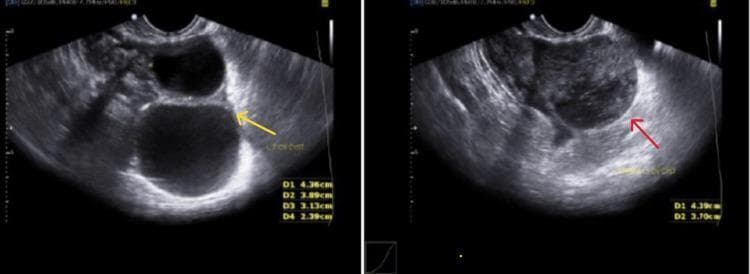 This diagnostic image consists of two side-by-side transvaginal ultrasound frames demonstrating ovarian pathology in a 27-year-old female. The left panel shows a simple ovarian cyst (indicated by a yellow arrow). It is characterized by a well-defined, thin-walled, anechoic (black) fluid-filled sac with acoustic enhancement posteriorly, representing a classic simple cyst morphology. The right panel demonstrates a complex ovarian cyst (indicated by a red arrow). This structure is characterized by a heterogeneous and disorganized internal architecture, containing low-level internal echoes and thickened, irregular borders, which contrast with the clear fluid of the simple cyst. Both images include linear measurement callouts in the bottom-right corners (e.g., D1, D2) for volumetric assessment. These findings are clinically significant in the differential diagnosis of adnexal masses, particularly in cases of suspected ectopic pregnancy or hemorrhagic cysts, where distinguishing between simple fluid and complex internal debris is critical for determining management pathways.