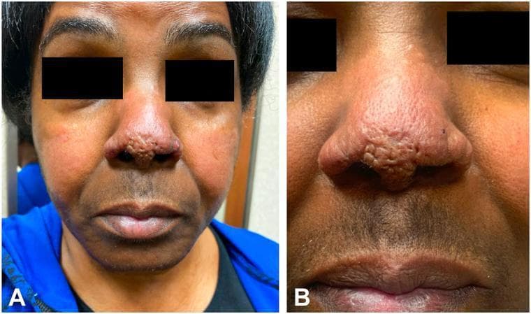 Clinical photograph of a 63-year-old African American woman displaying characteristic cutaneous manifestations of lupus pernio, a form of sarcoidosis. Figure A shows a frontal view of the face with indurated, violaceous-to-hyperpigmented papules that have coalesced into a plaque on the nasal tip and bilateral alar rims, creating a distinctive 'cobblestone' texture. Erythematous to hypopigmented patches are visible on the medial cheeks, notably sparing the nasolabial folds. An erosion on the left alar rim indicates a prior biopsy site. Figure B provides a close-up view highlighting the atrophic and firm papules along the nasal tip and left alar rim. These findings are highly suggestive of chronic sarcoidosis, often associated with upper respiratory tract involvement and systemic disease. The educational focus is on the morphology and distribution of sarcoidal skin lesions on the central face.