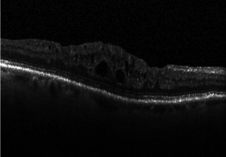 This diagnostic image is an Optical Coherence Tomography (OCT) cross-sectional scan of the human retina, illustrating classic features of Diabetic Macular Edema (DME). The scan shows the characteristic anatomical layers of the retina, with a prominent hyperreflective band at the base representing the retinal pigment epithelium (RPE) and Bruch's membrane complex. The primary pathological finding is significant retinal thickening and distortion of the foveal contour. Within the inner and middle retinal layers, multiple hyporeflective, cyst-like spaces are visible, representing intraretinal fluid accumulation (cystoid macular edema). These cystic spaces vary in size and shape, causing displacement and architectural disruption of the surrounding neurosensory retinal tissue. The image is a critical educational tool for ophthalmology, demonstrating the diagnostic utility of OCT in identifying and monitoring macular edema resulting from diabetic retinopathy.
