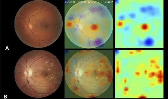 This comparison chart displays fundus photography and corresponding deep learning attention maps used in the classification of diabetic retinopathy (DR). The image is divided into two rows: Row A represents a healthy retina, and Row B represents a retina with diabetic retinopathy. Each row contains three panels: the original clinical photograph, an overlaid saliency/attention map, and a standalone heatmap. The heatmaps utilize a color spectrum where yellow and red indicate regions of high relevance to the model's decision-making process. In row A (healthy), the model shows localized focal attention near the optic nerve head and macula. In row B (DR), the attention map reveals a diffuse and widespread distribution of high-relevance pixels (red/yellow), corresponding to pathological lesions such as microaneurysms, hemorrhages, and hard exudates scattered across the fundus. This visualizes Class Activation Mapping (CAM) techniques used in artificial intelligence to identify clinically significant features and improve the interpretability of automated screening for retinal diseases.