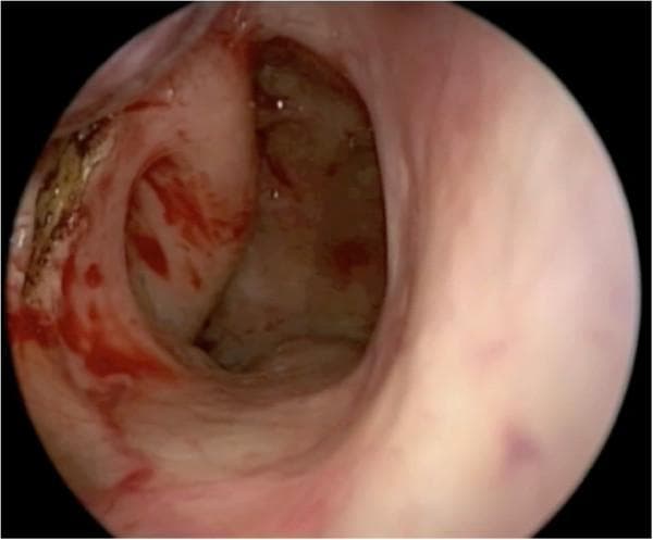 This endoscopic clinical photograph demonstrates an intraoperative view of the posterior nasal cavity and nasopharynx during the harvest of a pedicled posteriorly-based inferior turbinate flap (PPITF). A prominent vertical mucosal incision is visible, serving as the posterior limb of the flap harvest. This incision is strategically positioned anterior to the torus tubarius and the Eustachian tube orifice. The surgical site shows expected post-procedural findings, including localized mucosal erythema, mild edema, and spots of fresh blood. Areas of brownish discoloration are visible along the incision margins, consistent with the use of needle-tipped monopolar cautery for hemostasis and precise tissue dissection. The surrounding anatomy includes the fleshy contours of the lateral nasal wall and the transition to the nasopharyngeal mucosa. This image is used to teach surgical landmarks for endoscopic endonasal skull base reconstruction and flap harvesting techniques, emphasizing the preservation of the Eustachian tube while ensuring adequate flap dimensions.