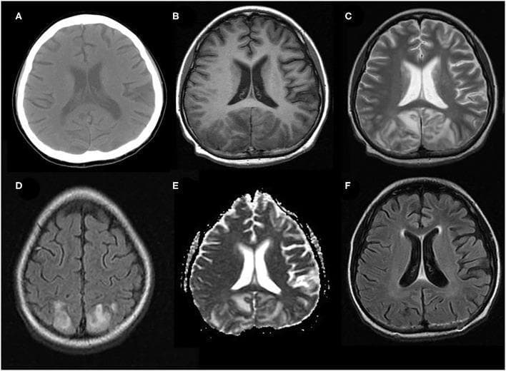 A composite diagnostic image set displaying typical neuroimaging findings of Posterior Reversible Encephalopathy Syndrome (PRES) in a pediatric patient. (A) Unenhanced axial brain CT shows subtle, symmetrical cortico-subcortical hypodensities in the bilateral parieto-occipital regions. (B-E) Acute stage axial MRIs further characterize these lesions: (B) T1-weighted MRI shows hypointensities; (C) T2-weighted and (D) T2-FLAIR MRI sequences reveal prominent, symmetrical hyperintensities consistent with vasogenic edema; and (E) the Apparent Diffusion Coefficient (ADC) map shows corresponding hyperintensity, indicating absence of diffusion restriction. (F) Follow-up axial FLAIR MRI at two months demonstrates complete resolution of the previous abnormal signal intensities, highlighting the reversible nature of the pathology. The primary educational focus is the recognition of classic parieto-occipital distribution and the signal characteristics (T2/FLAIR hyperintensity and high ADC) that distinguish vasogenic edema in PRES from cytotoxic edema in acute infarction.