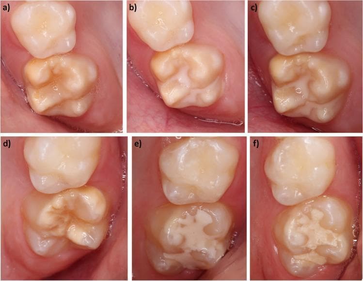 Clinical intraoral photographs documenting a longitudinal study of dental fissure sealants in a human patient. The composite image compares two different sealant materials over a 12-week period. Panels (a-c) show tooth 16: (a) baseline with natural occlusal grooves; (b) immediate post-application of Clinpro™ Sealant, showing a smooth, opaque white layer covering the pits and fissures; (c) at 12 weeks, showing high retention with minor surface texture changes. Panels (d-f) show tooth 26: (d) baseline; (e) immediate post-application of Ketac™ Universal glass ionomer sealant; (f) at 12 weeks, demonstrating significant material loss and partial retention, with exposed enamel and fragmented sealant remaining in the central occlusal area. The series illustrates clinical evaluation criteria such as retention, marginal integrity, and surface texture in restorative dentistry. The images highlight the differing durability and wear patterns between resin-based and glass ionomer-based sealing materials in pediatric or preventive dentistry.