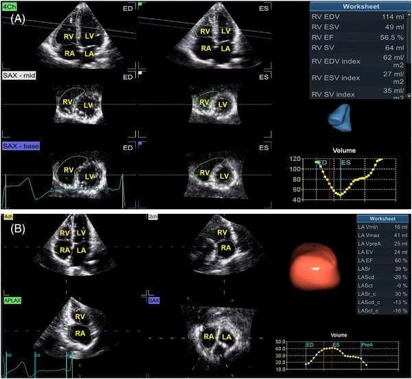 Educational diagnostic graphic depicting 4D echocardiographic analysis of cardiac chambers. Panel A illustrates right ventricular (RV) quantification using 4D Auto RVQ, showing 4-chamber (4Ch), mid-short axis (SAX-mid), and basal short axis (SAX-base) views at end-diastole (ED) and end-systole (ES). Key anatomical structures labeled include the RV, left ventricle (LV), right atrium (RA), and left atrium (LA). A quantitative worksheet lists RV end-diastolic volume (EDV), end-systolic volume (ESV), ejection fraction (EF), and stroke volume (SV), alongside a 3D reconstruction and a temporal volume-change graph. Panel B demonstrates right atrial (RA) geometry and function assessment via 4D Auto LAQ software. It presents 4Ch, 2-chamber (2ch), apical long-axis (APLAX), and short-axis (SAX) orientations. Quantitative metrics include maximal volume (Vmax), minimal volume (Vmin), emptying volume (EV), and fractional volume changes (LASr, LAScd). These images exemplify advanced ultrasound imaging for volumetric and functional assessment of the right heart chambers in clinical cardiology.