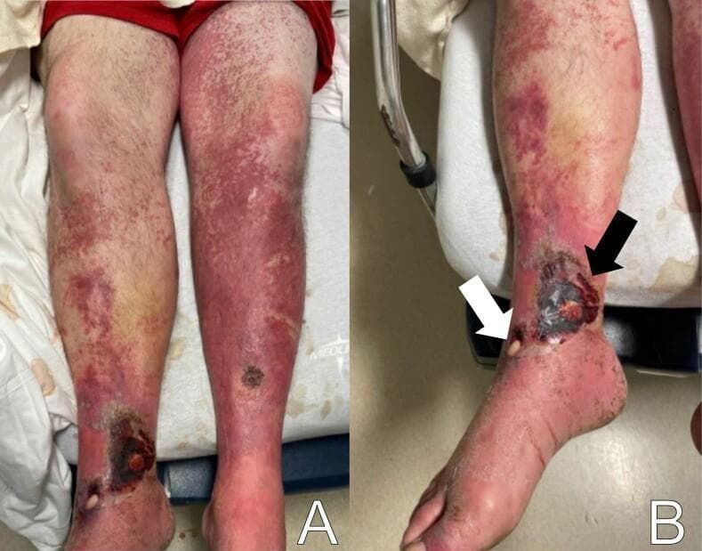 Clinical photograph of the bilateral lower extremities in a 45-year-old male, demonstrating complex dermatological and vascular findings. Panel A shows an extensive, bilateral, erythematous, papular, and non-blanching rash extending from the anterior thighs to the dorsal feet, suggesting a vasculitic or inflammatory etiology. Panel B provides a detailed view of the right ankle, highlighting severe skin lesions. A white arrow indicates a shallow, circular ulceration with a pale, membranous covering. An adjacent larger lesion, indicated by a black arrow, shows dense, dark eschar indicative of tissue necrosis. The surrounding skin exhibits generalized erythema, scaling, and edema consistent with cellulitis or chronic venous insufficiency. These images are educationally significant for distinguishing between different types of lower extremity wounds, including membranous ulcers and necrotic eschar, and identifying the characteristic appearance of a non-blanching purpuric rash.