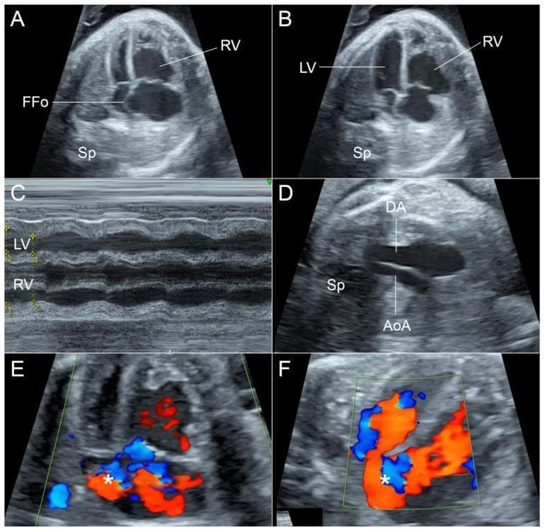 This composite figure presents a detailed fetal echocardiographic evaluation at 35 weeks of gestation. Panels A and B (four-chamber views) demonstrate significant chamber disproportion, with a dilated right ventricle (RV) compared to the left ventricle (LV). The flap of the foramen ovale (FFo) appears relatively fixed and exhibits tense bulging throughout both systole (A) and diastole (B). Panel C (M-mode) confirms impaired RV contractility, showing a reduced shortening fraction compared to the LV. Panel D (three-vessel and trachea view) reveals a hypoplastic aortic arch (AoA) in comparison to the larger ductus arteriosus (DA). Panels E and F utilize color Doppler imaging to illustrate abnormal hemodynamics at the interatrial septum, characterized by turbulent blood flow (marked with asterisks) and restricted passage across the foramen ovale. These findings are clinically significant for identifying secondary cardiac changes due to fetal anemia and altered preload conditions, emphasizing the assessment of the foramen ovale and ventricular function in high-risk pregnancies.