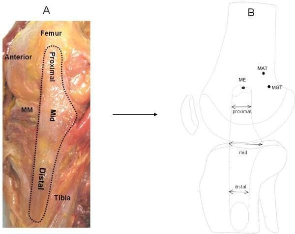 This composite image illustrates the anatomy and morphometry of the superficial medial collateral ligament (sMCL) of the knee. Image A is a clinical photograph of a right cadaveric knee dissection in the medial view. The sMCL is outlined and partitioned into proximal, mid, and distal segments. It demonstrates the ligament's broad, fan-like structure originating from the femur and inserting onto the tibia, noting its close anatomical relationship with the medial meniscus (MM). Image B is a corresponding schematic diagram used for quantitative morphometric analysis. It identifies three key femoral landmarks: the medial epicondyle (ME), medial adductor tubercle (MAT), and medial gastrocnemius tubercle (MGT). Arrows indicate the anteroposterior width measurements at the proximal, mid, and distal levels of the sMCL. The diagram highlights the characteristic triangular or hourglass morphology where the mid-portion at the joint line is significantly wider than the proximal and distal segments. This educational material is designed for orthopedic and anatomical studies focusing on knee ligamentous stability and surgical landmarks for MCL reconstruction.
