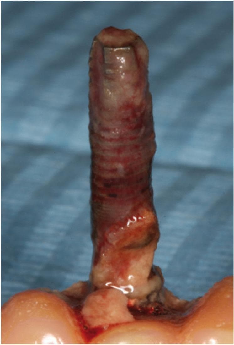 This clinical photograph displays a failed dental implant within an intraoral setting, illustrating severe peri-implantitis and implant failure. The visual focus is on a vertically oriented titanium implant fixture that exhibits extensive exposure of its threaded surface, indicating profound marginal bone loss and loss of osseointegration. The surrounding soft tissues are pathologically altered, appearing erythematous (dark red) and edematous, suggesting active inflammation and mucositis. At the base of the implant, there is evidence of gingival recession and irregular tissue attachment. The overall presentation serves as a teaching case for complications arising from the lack of supportive periodontal therapy (SPT), highlighting the progression from peri-implant mucositis to significant peri-implant bone destruction and ultimate fixture failure.